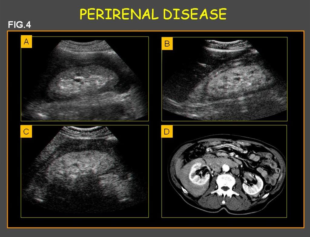 Fig. 0: Fig.4: US, CEUS and CT of perirenal lymphoma.(a) Longitudinal ultrasound shows an inhomogeneous hypoechoic perirenal soft tissue.