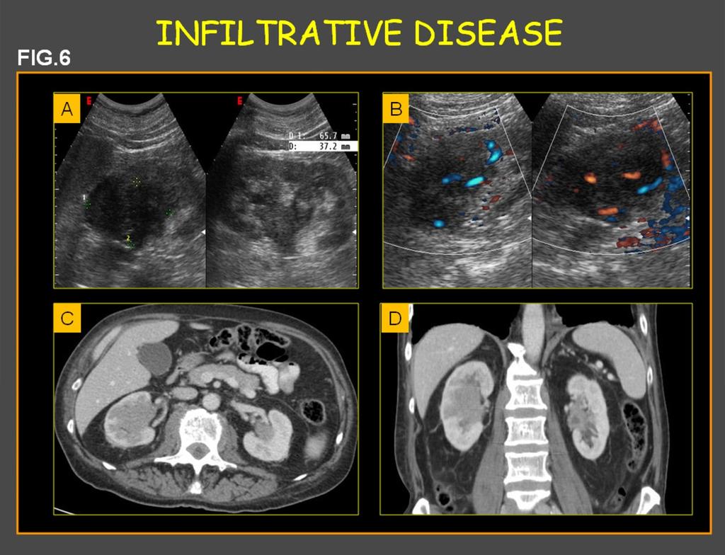 Fig. 0: Fig.6: (A) Baseline ultrasound images show a inhomogeneous hypoechoic nodules that invade the renal sinus. (B) Color- Doppler ultrasound shows a significative vascularity within the nodules.