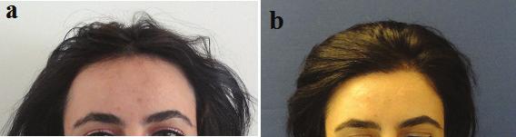 Figure 11. (a) Preoperative 30 years old women has large forehead, (b) 1 year later after hair transplant.