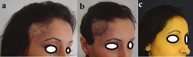 Deformities of the frontal bone and burn sequelae near the hairline can also be masked with hair transplantation (Figure 12).
