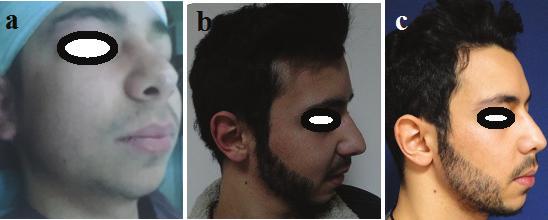 280 Hair and Scalp Disorders Figure 13. (a) Preoperative photo beard transplant, (b) Postoperative 1 year later, (c) postoperative 2 years later. Figure 14.