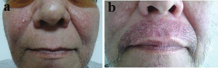 281 Figure 15. (a) 55 years old man Preoperative photo, (b) 10 days later after mustache transplant. Figure 16.