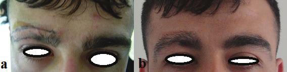 (a) Preoperative photo brow loss, (b) 2 years later brow transplant. 2.9.