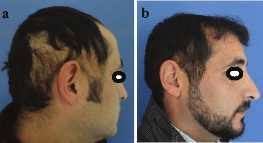 282 Hair and Scalp Disorders Figure 18. (a) Preoperative photo of burn scar patient, (b) 2 years later hair transplant. Figure 19.