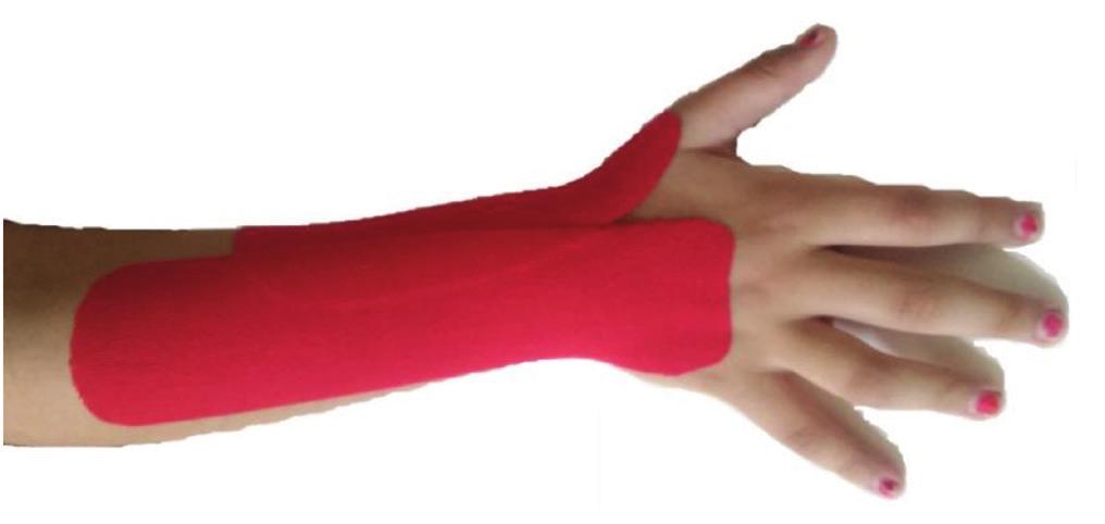 1- children with cerebral palsy, confirmed by pediatric neurologist, 2- Hand and/or wrist spasticity less than three according to Modified Ashworth Scale (MAS), 3- have thumb in palm and wrist