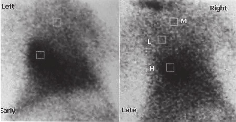 Fig. 1 123 I-MIBG scintigraphy was shown at early (15 minutes) and late (3-hours) phases. Regions of interests from the heart (H), mediastinum (M) and lung area (L) were drawn. Fig.