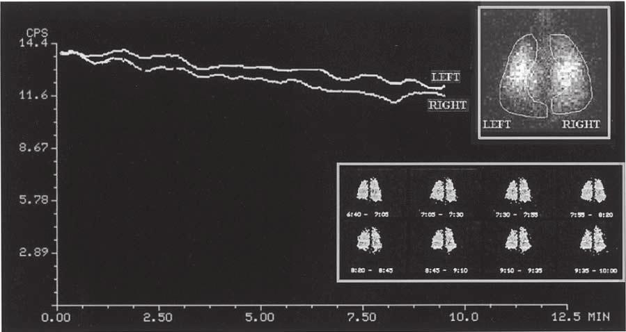 The clearance rate 99m Tc-DTPA (T½ ) for right lung is 130 min. of AIPT. 6 In another experimental study, Capa Kaya et al.