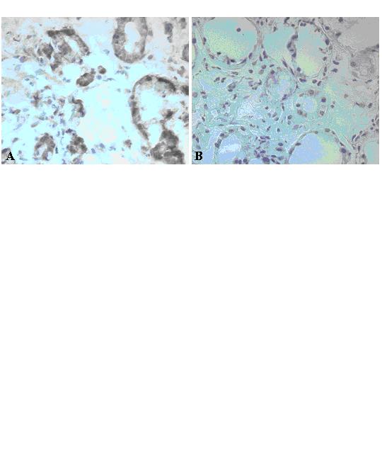 Figure 4 Photomicrographs representative of immunostaining of asthmatic and healthy bronchial biopsy sections with an A 1 receptor antibody.