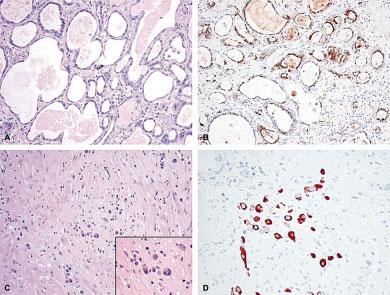 NE Differentiation in Esophageal Cancer/Wang et al.