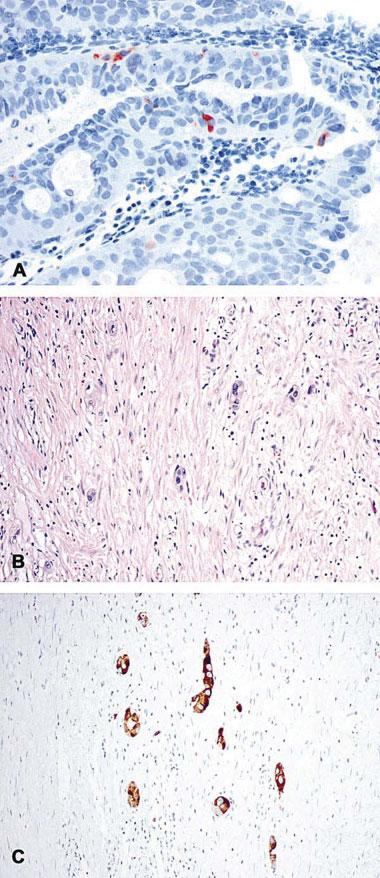 1470 CANCER October 1, 2006 / Volume 107 / Number 7 TABLE 2 Extent of Neuroendocrine Differentiation in Biopsy and Resected Specimens for Esophageal and EGJ Adenocarcinomas by Chromogranin A and