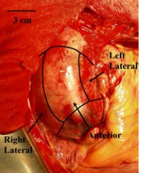 Figure 1.17: in vivo ATAA at the aortic root 1.3.2 Biomechanical properties of ATAA After a pathological aneurysm, the mechanical characteristics of the tissue change.