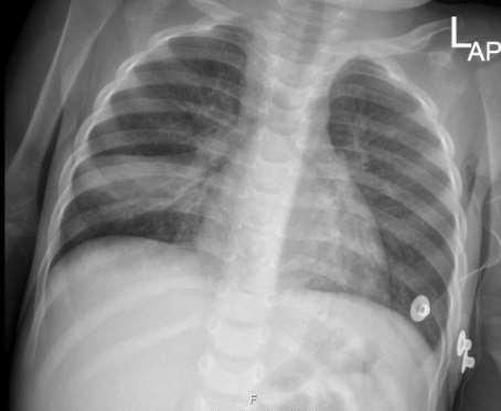 Case report 2 nd admission - May 2016 CXR -