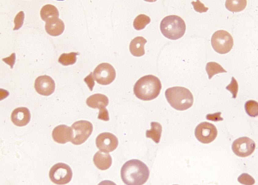 Thrombotic Thrombocytopenic Purpura A Disorder of VWF Proteolysis A classic pentad of signs: Microangiopathic hemolytic anemia Thrombocytopenia (Neurologic