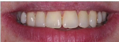 Clear smile aligner is the ideal treatment for mild to moderate crowding or misalignment of the