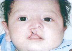 by donating online at smiletrain.org or casaazulac.org. More than 170,000 children are born with clefts each year.