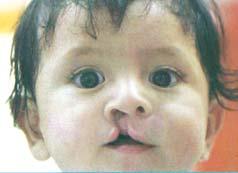 Casa Azul was founded in 2003 to make it possible for children with clefts and other facial