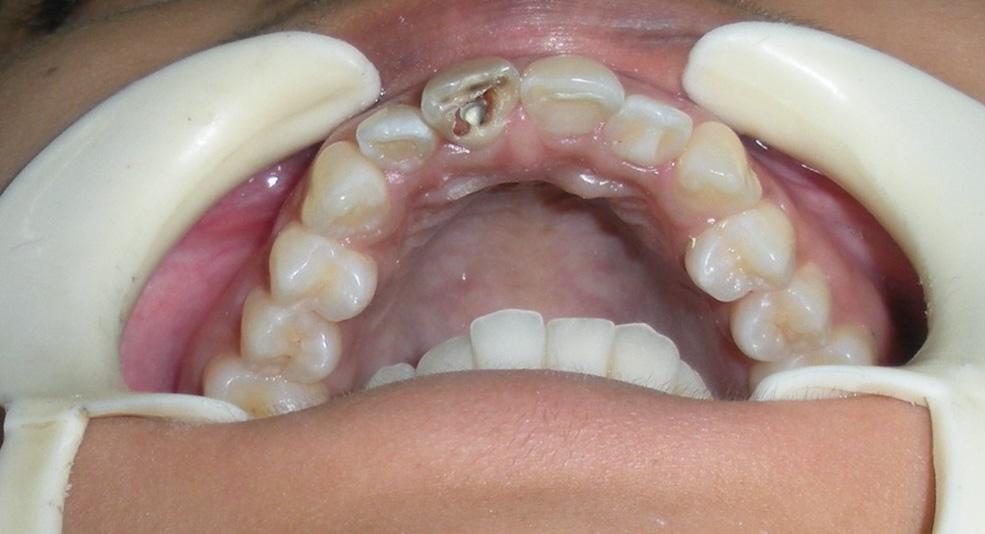 Figure 5: IOPA showing perforation