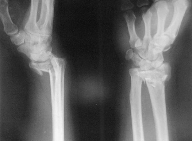 Treatment of distal radius fractures using AO external fixators in conjunction with radial shortening of more than 5 mm and/or intra-articular involvement in the radiocarpal or radioulnar joint,