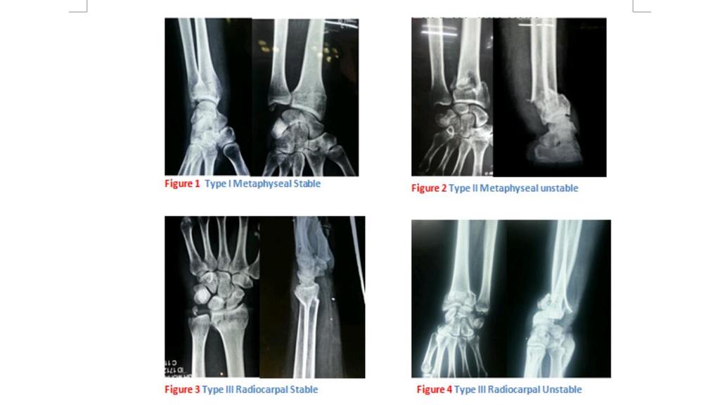 9 X- Rays showing different types of distal end radius fractures based on Barzullah working classification References: 1. Pouteau, C.: Oeuvres Posthumes de M Pouteau, Paris, P.D.