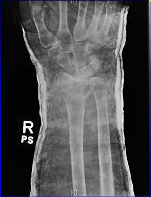 Results: At Union Lafontaine Total Ulnar Variance Radial Height Radial Inclination P <.0001 P <.