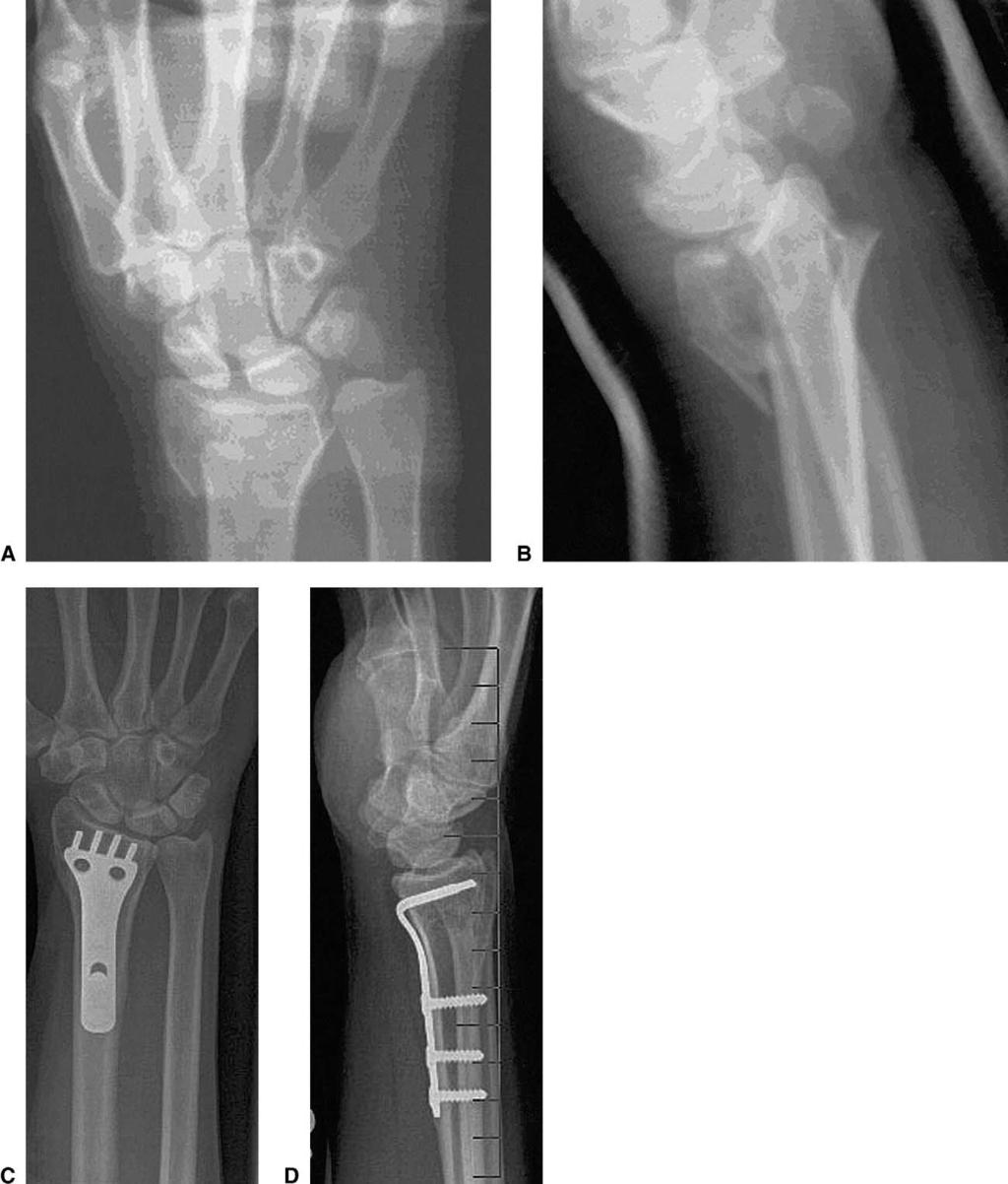 296 The Journal of Hand Surgery / Vol. 30A No. 2 March 2005 Figure 9. Patient with comminuted displaced intra-articular radius fracture with significant scapholunate injury.