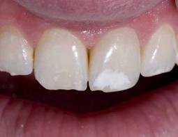 Dental fluorosis Dental fluorosis is a condition of enamel hypomineralization because of the effects of excessive fluoride on