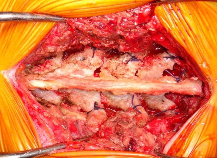 mimicking spinal metastasis by frozen recapping laminoplasty in a patient with