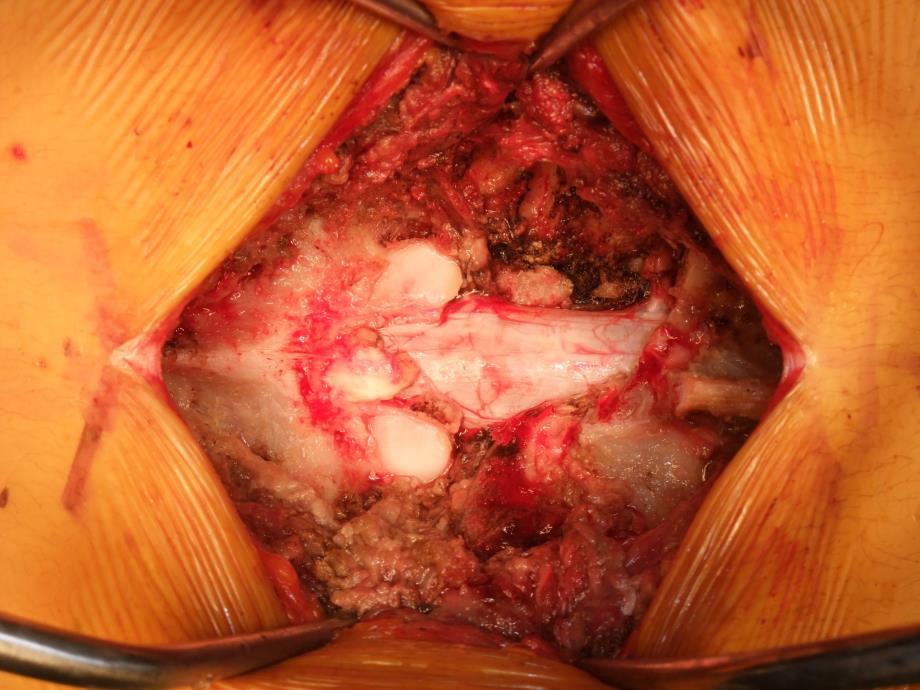 opposite side of the tumor, using a flexible multifilament threadwire saw (T-saw; Promedical Co, LTD, Kanazawa, Japan).