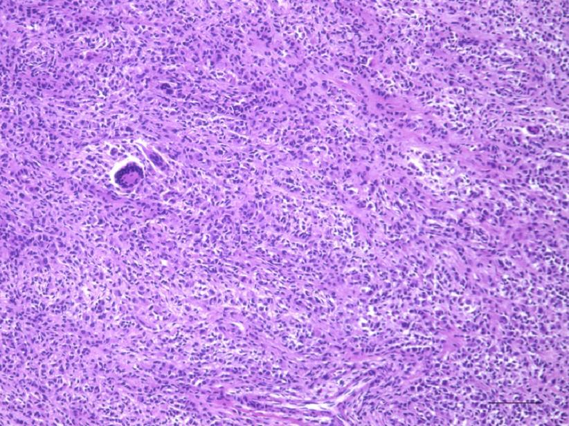 Pathological findings of the resected tumor (hematoxylin and eosin staining) Pathological analysis revealed synovial-type tissue with a fibrohistiocytic reaction.