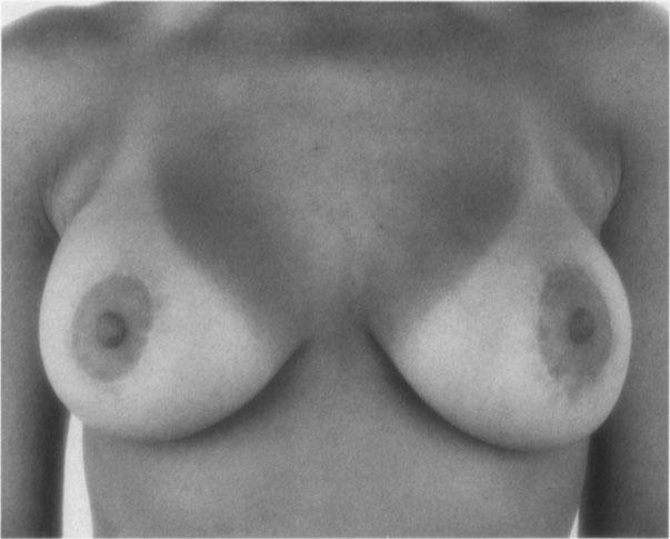 woman with breast underdevelopment