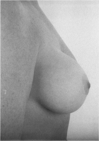 breast implantation through a periareolar