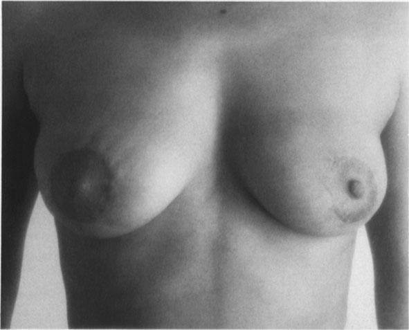 27-year-old woman with breast