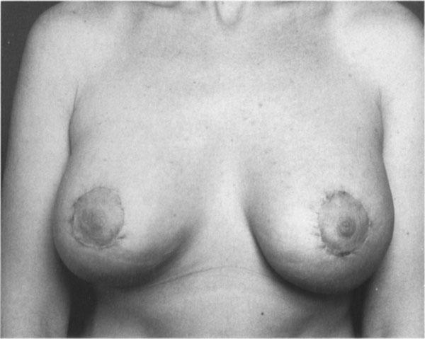 woman with breast ptosis and