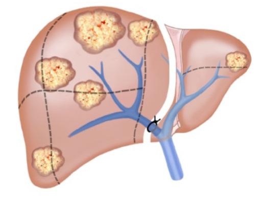 Associating Liver Partition with Portal