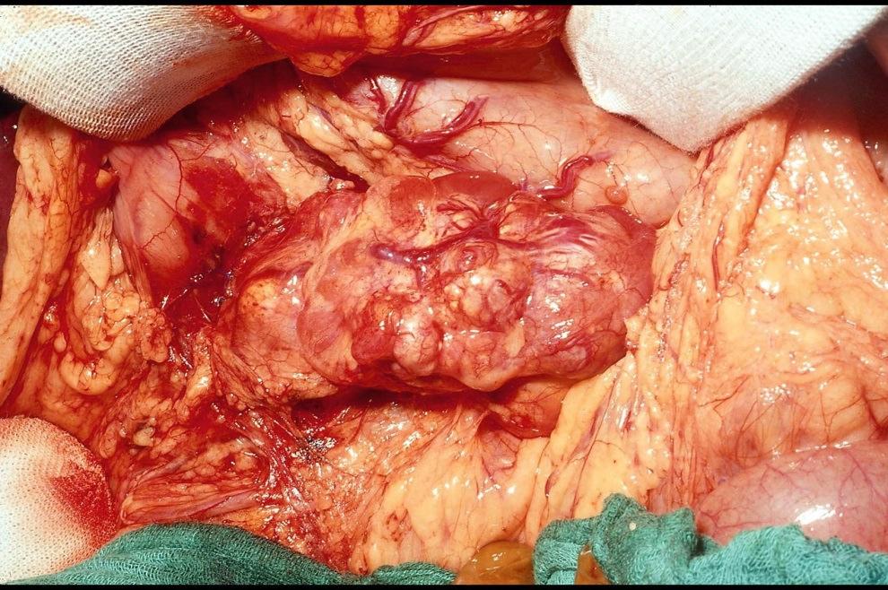 Gastrinoma -MEN 1 - Distal pancreatectomy Spleen saving Resection of NE tumors Head Uncinate process Duodenotomy