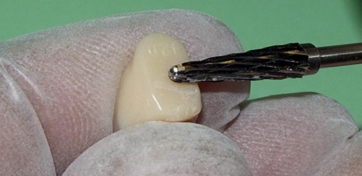 GIUD LINE FOR SETTING ANTERIOR TEETH 1. Replace the acrylic resin record base attached to the framework with the base-plate wax base. 2.