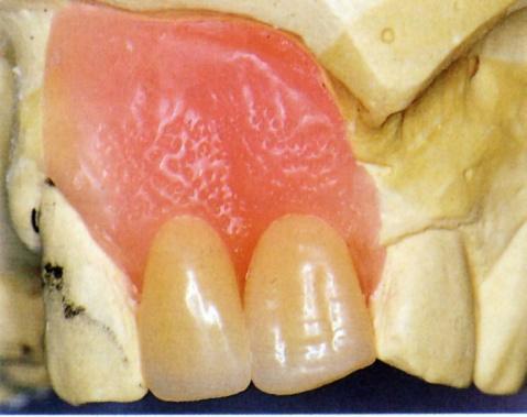 If required reshape the ridge lap portion of the artificial tooth without shortening the clinical crown length substantially.