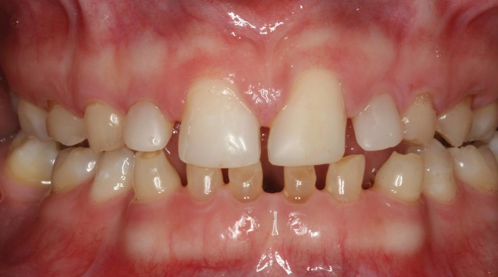 Now 25 years old, she had no cavities or signs of gum disease.