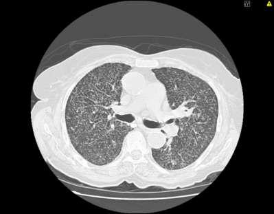 Diagnosis 3 Exclusion of other competing diagnosis /confounders/diseases that mimic pneumoconiosis IPF (smoking related and
