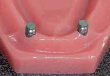 denture base with