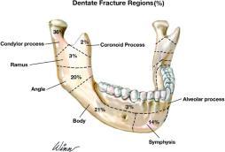 Mandible fractures: Brief clinical exam: