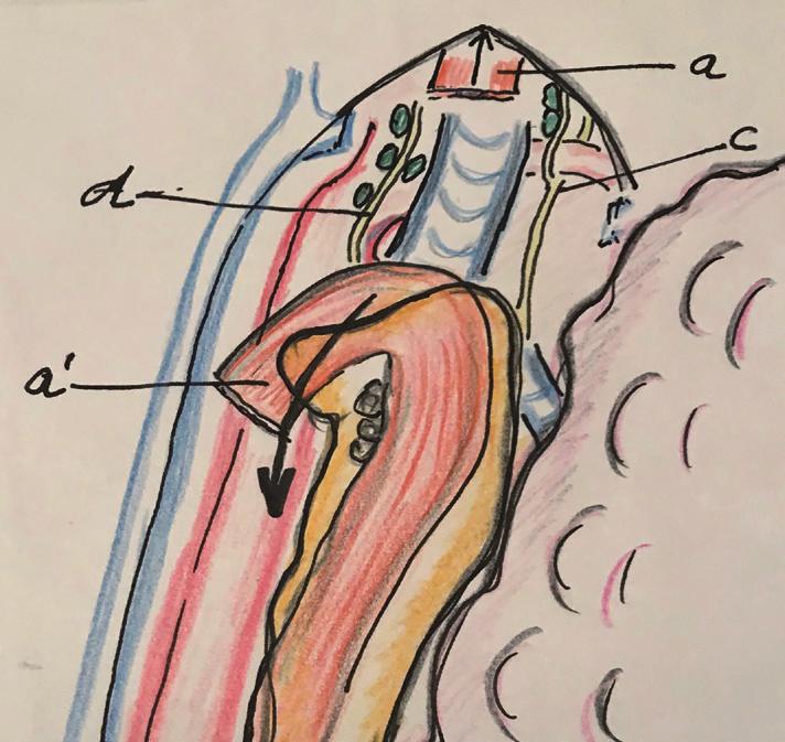 Journal of Thoracic Disease, Vol 11, Suppl 5 April 2019 S767 esophagus is kept attached to the left upper mediastinum and after division the tissue including the LRLN and lymph nodes remain attached