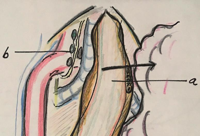 This proximal esophagus and tissues are drawn through a gap between the vertebral body and the scapula obtaining an optimal operative field for the lymphadenectomy.