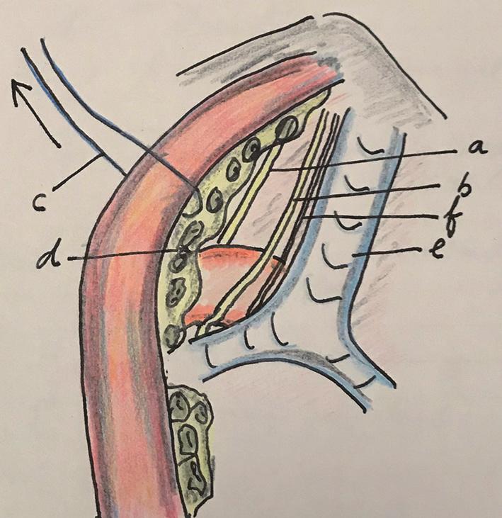 a: right vagal nerve; b: pretracheal lymphadenectomy specimen; c: left recurrent laryngeal nerve lymph nodes; d: tracheoesophageal artery; and e: thoracoscope.