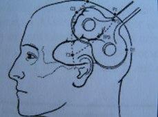 rtms for auditory hallucinations