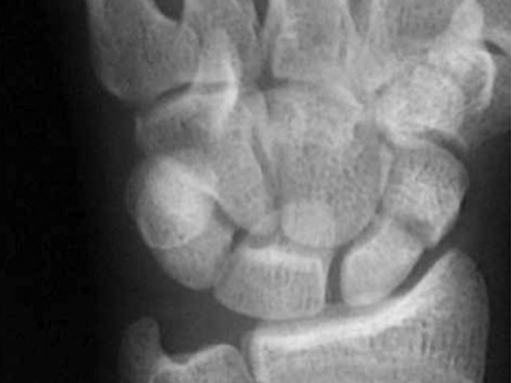 Angle between tangential lines drawn along the flattest portion of the dorsal cortices of the proximal and distal scaphoid fragments on a lateral view.