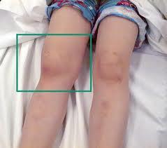Exam I: Large swelling of knee P: Diffuse Tenderness, moderate effusion of knee R: Decreased Knee