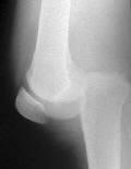 Knee Joint Dislocation High impact mechanism Tibia dislocated from femur All stabilizing ligaments of knee torn