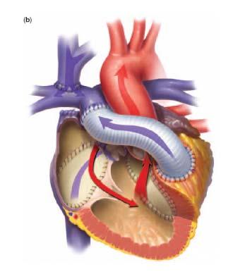 Hemi-Mustard procedure Reduces complexity of the intraatrial procedure Reduces myocardial ischemia time Recognized complications, such as SVC obstruction, pulmonary