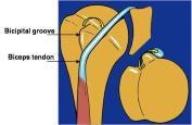 Tenotomy Tenodesis Biceps instability Isolated biceps instability Transverse humeral ligament tear Often associated